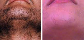 Hair generally grows all over the human body, some fine and barely noticeable, with other areas having thicker, more prominent hair. Laser Hair Removal For Men London Laser Clinic