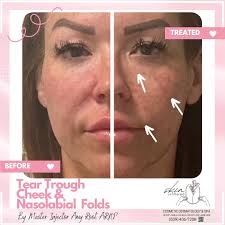 ✨ Transform Your Look with Skin Unfiltered in Zillah, WA!✨ Check out these  before and after results of Nasolabial Folds, Cheeks, and Tear Troughs  treatments by our expert Master Injector Amy Root,