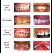Gigi kuning disebabkan juga proses penuaan. Siakap Keli Yang Mana Satu Gigi Anak Anda Gigi Yang Sihat Berwarna Putih Susu Permukaannya Licin Ruang Antara Gigi Itu Normal Untuk Tumbesaran Gigi Kekal Nanti Tompok Putih Itu