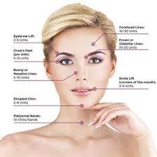 Image Result For Botox Injection Sites Chart Botoxgonewrong