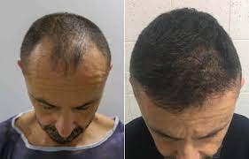 94% of patients start growing hair gradually after the hair falls off. Before And After Hair Transplant Step By Step Situation Rephair