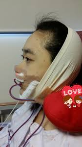Check Out This Blog To See Her Before And After Surgery Experience Diary At Id Hospital She Underwent Doubl Jaw Surgery Double Jaw Surgery Facial Contouring