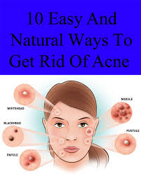 10 Easy And Natural Ways To Get Rid Of Acne How To Get Rid Of Acne Acne Acne Scar Removal