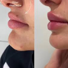 Lip Filler Migration: The Most Important Things You Need To Know - Cosmetic  Connection