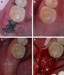 Of course, these basic instructions we must comply but there are still some details patients need to know after tooth extraction. A Clinical Photograph Of The Tooth 47 Extraction Socket After 7 Days Download Scientific Diagram