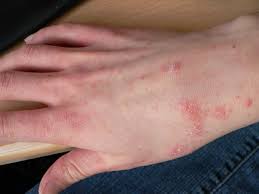 Image result for scabies on genitals