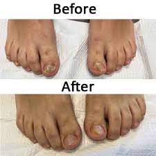 Toenail Fungus Before And After Photos Podiatrist In Manhasset Huntington Plainview Maspeth Great Neck Ny