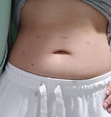 After your gastric sleeve surgery, you will wake up in the hospital, a bit tired, and without a lot of pain. Incision Scars I M 1y 3m Out This Is How My Scars Look So Far How Have Your Scars Faded Wls