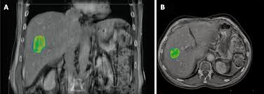 What does stage iv mean? Metastatic Spanish Definition