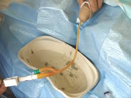 Image result for Urethral Catheterization