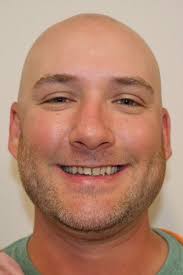 Before & After Smile Makeover in Woburn, MA