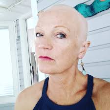 Diagnosed with invasive lobular carcinoma in November of last year. Had  lumpectomy Feb 10. First chemo treatment may 12. Starting to lose my hair.  Have 3 more treatments. Each 3 weeks apart.