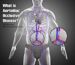 Aortoiliac Occlusive Disease Causes Symptoms Treatment Prevention Diagnosis