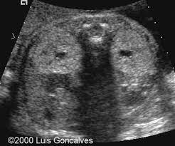 Adult Polycystic Kidney Disease