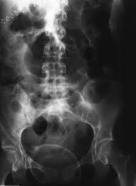 Image result for Adynamic Ileus