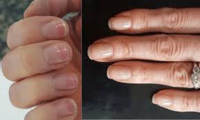 My nails are super thin sore and red after removing acrylic nails. Best Treatments For Nail Recovery After Acrylics Before And After Nails After Acrylics Nail Repair Nail Care Routine