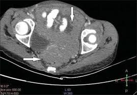 ct scans are often used to help look for mesothelioma and to find the exact location of the cancer. Malignant Pleural And Peritoneal Mesothelioma Consequential To Brief Indirect Asbestos Exposure Journal Of Clinical Imaging Science