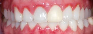 Image result for Gingivitis