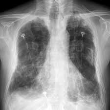 A full time gp is likely to diagnose approximately one person with lung cancer each year. Asbestos Related Lung And Pleural Disease Radiology Case Radiopaedia Org