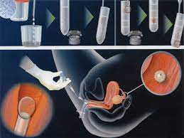 Pin On Intrauterine Insemination Iui