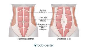• list the chest muscles • list the abdominal wall muscles chest/thoracic wall provides protection to vital organs • describe the attachments of the above mentioned o heart and major vessels, lungs, liver figure 2. Diastasis Recti During Or After Pregnancy Symptoms Exercises Pictures Babycenter