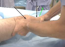 Image result for Lachman Test