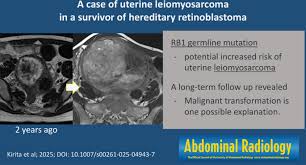Image result for Leiomyosarcoma
