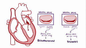 It is a heart valve with two valves, which is located between the left atrium and the left ventricle. Mitral Valve Disease Osmosis