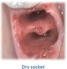 How do you know if you get dry socket. Dry Socket Stitches Novocom Top