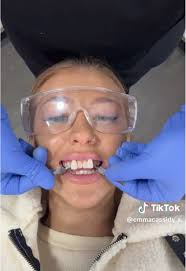 veneers incoming with @emmacassidy.x #westerwood #westerwoodhealth  #compositebonding #invisalign #teethwhitening #teethwhitening #glasgow  #veneers #emax