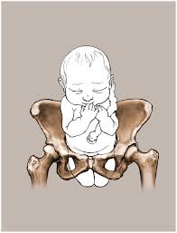 Image result for Breech Delivery