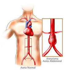 O grande perigo é o rompimento. Aneurisma Da Aorta Abdominal Farmacia Saude
