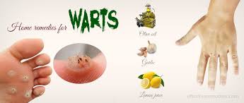 To Remove Warts Don T Skip These Natural Effective Remedies Home Remedies For Warts Warts Remedy Warts On Hands