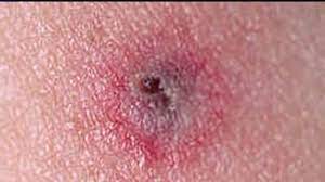 Pennsylvania Ranked Number One For Reported Cases Of Lyme Disease As Advocates Rally In Harrisburg For Change Fox43 Com