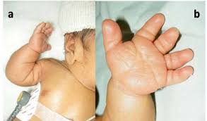 Check spelling or type a new query. A Severe Micromelia And B Short Stubby Fingers Download Scientific Diagram