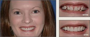 Local germantown dentist damion cooper gives his take on why having the perfect smile is so important. Smile Gallery Skin Makeup Cosmetic Dentist Smile Makeover