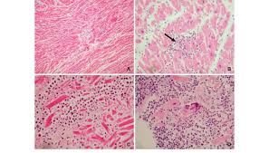 Prevalence of lymphocytic myocarditis among dcm subjects. Histopathological Findings Of Myocarditis A Florid Lymphocytic Download Scientific Diagram