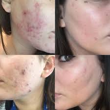 It's important to take the capsules as instructed by your doctor. Can Using Accutane In Low Doses Cure Acne Without Side Effects