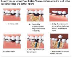 Pin On Dental Implants