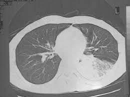 The chest radiograph reveals a left lower lobe opacity with pleural effusion. Left Lower Lobe Pneumonia Four Months Ago On Thorax Ct Download Scientific Diagram
