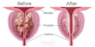 Frequent passing of urine, including at night; Rezum Water Vapor Therapy For Bph Enlarged Prostate
