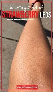 How To Get Rid Of Strawberry Legs In 5 Easy Steps Dennis Remedy Strawberry Legs Beauty Skin Care Health And Beauty
