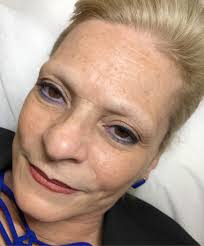 Case Study: Microblading for Mature Skin