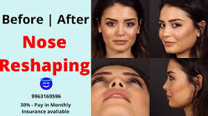 The cost can vary depending on the type of surgery. Rhinoplasty Nose Reshaping Cost In Hyderabad Nose Surgery Cost In Hyderabad Youtube