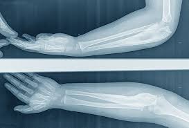Image result for Osteosarcoma