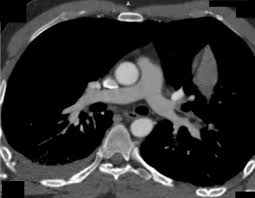 When a blood vessel (a vein or an artery) is injured, the body uses platelets. Embolia Pulmonar Grasa Presentacion De Un Caso Sciencedirect