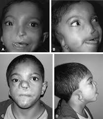 The surgical repair of half-nose