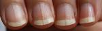 Solution contre les ongles stris - Dermatologue