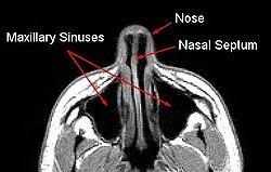 It extends from the nares anteriorly to the choanae posteriorly and is covered by squamous epithelium. Nasal Septum Wikipedia