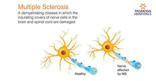 Multiple sclerosis research laboratory at mayo clinic Multiple Sclerosis Symptoms And Treatment Sclerosis Of The Spine Spine And Brain